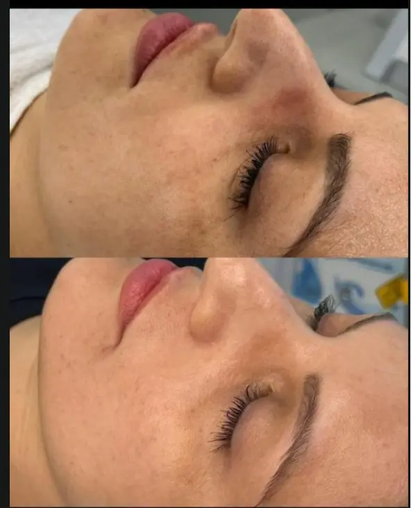 Resultado individual de cuidado estético facial