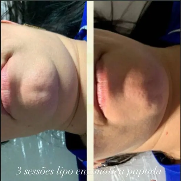 Resultado individual após protocolo estético facial