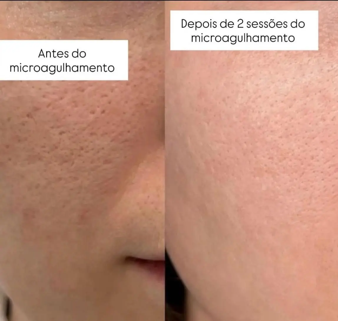 Comparação de pele antes e depois de duas sessões de microagulhamento