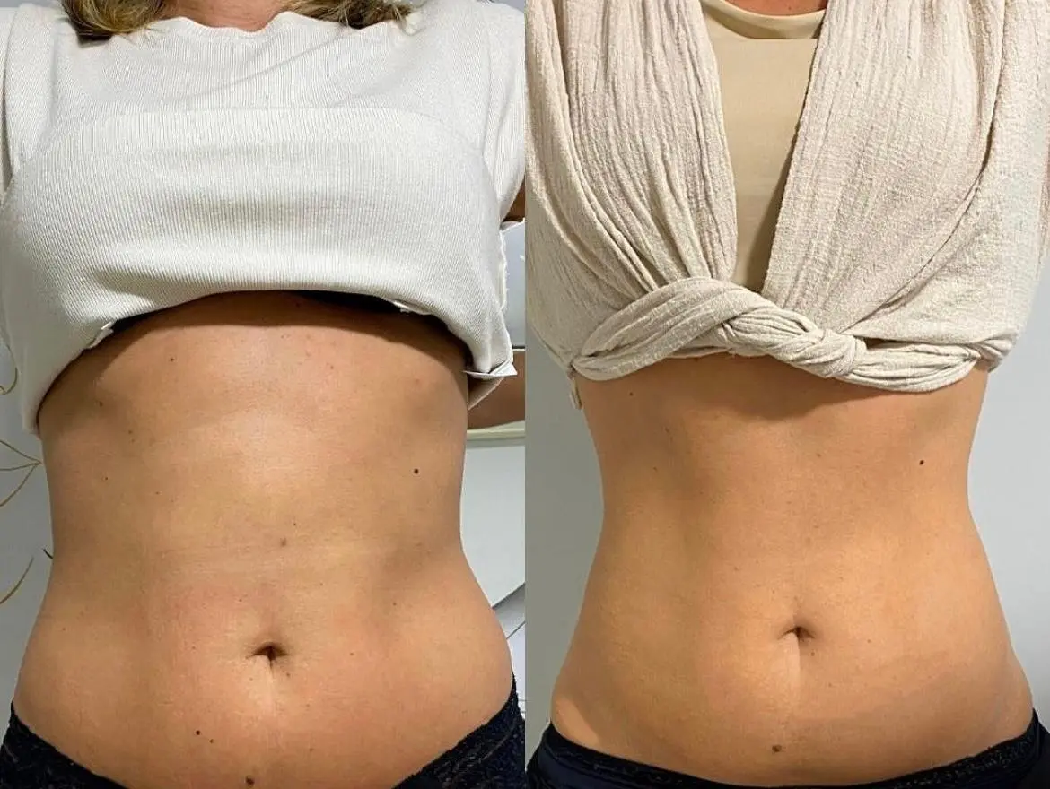 Comparação frontal antes e depois de protocolo corporal