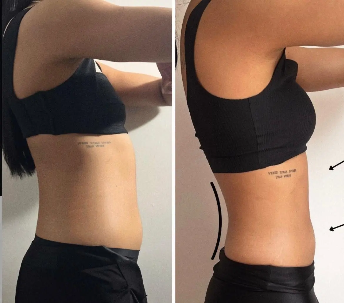 Comparação lateral antes e depois de protocolo corporal